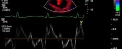 Echocardiographie du ventricule droit