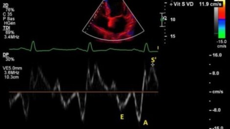 Echocardiographie du ventricule droit